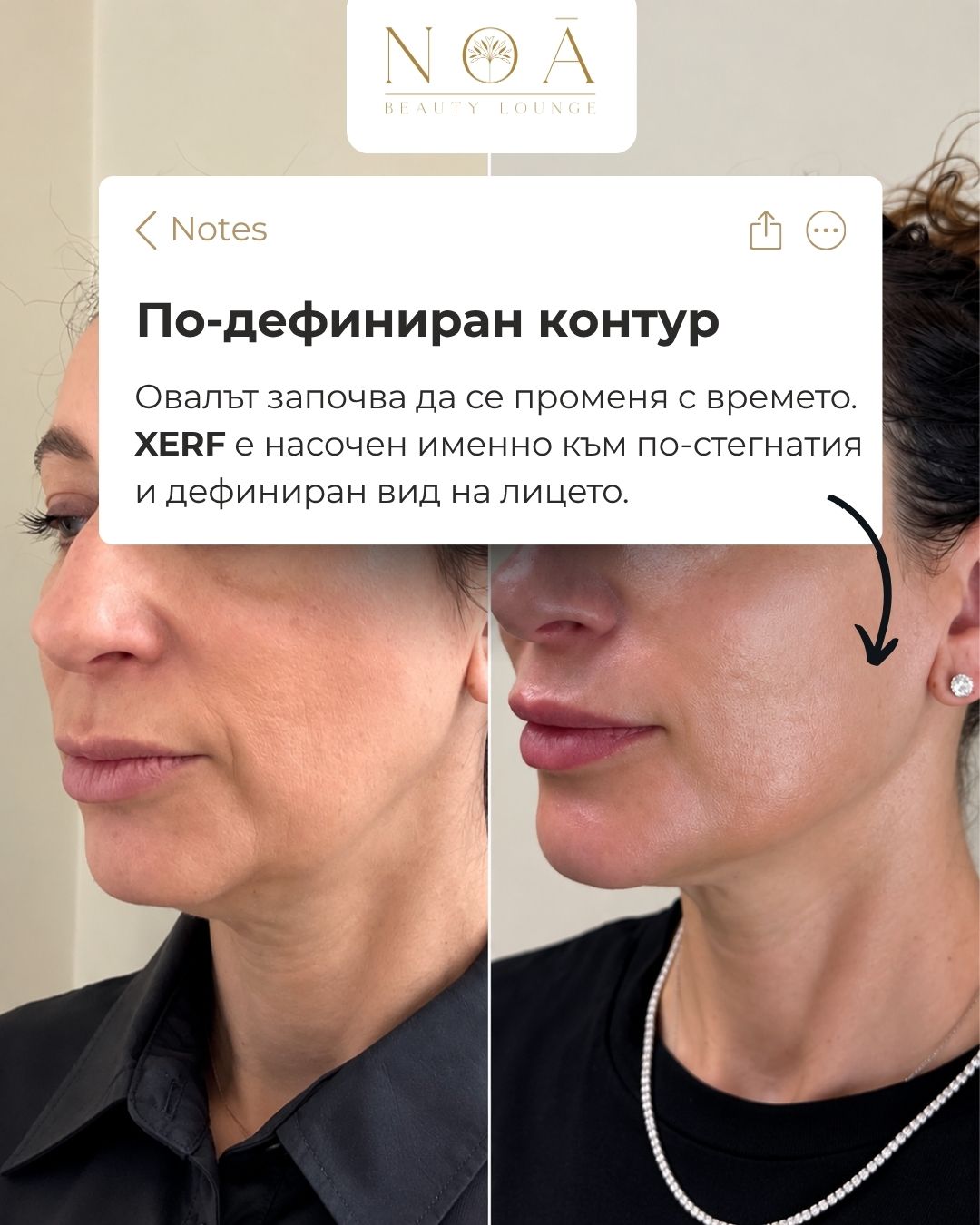 XERF – контур на лицето XERF за стягане на кожата и подобряване на контура на лицето