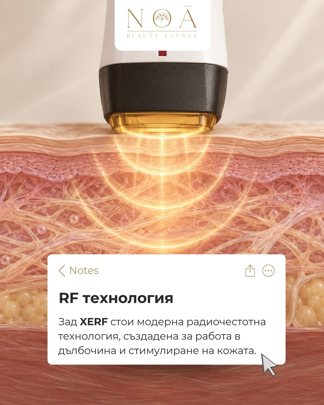 XERF – радиочестотна технология XERF радиочестотна технология за неинвазивен лифтинг