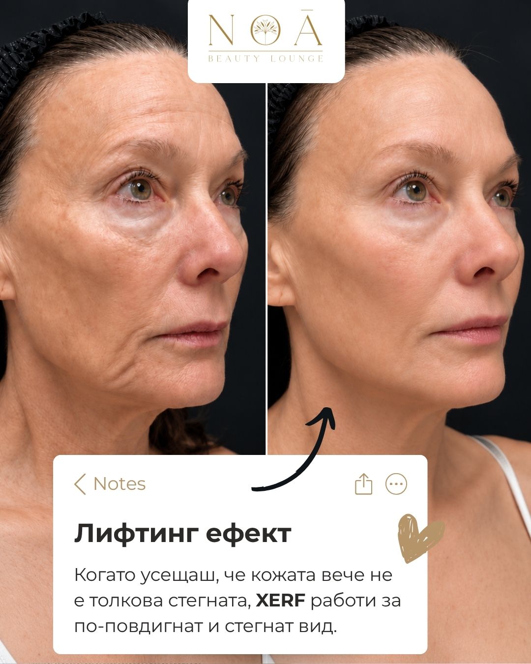 XERF – стягане на кожата XERF процедура за стягане на кожата на лицето